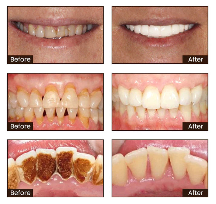 🔥Final - 3 Hours: 60% OFF Nicotinamide Whitening Toothpaste