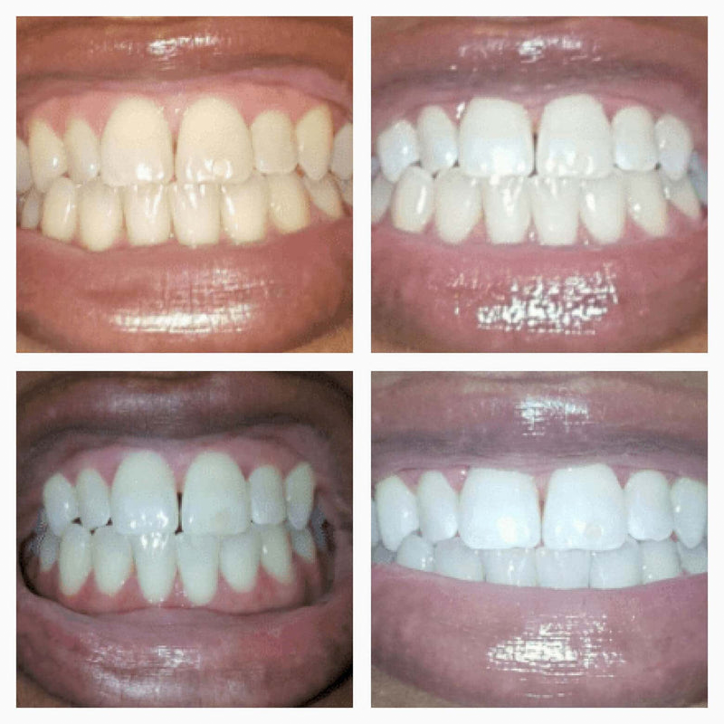 🔥 LAST DAY! 73% OFF FLASH SALE 💎 Diamond Whitening Pen | Visible Results in 7 Days ✨